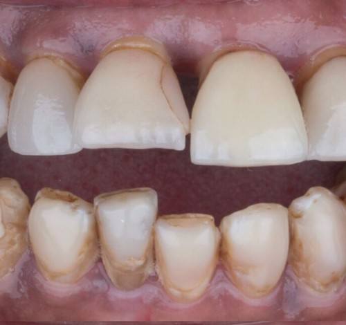 Dental Clinic Turkey Before After Picture Case 11 (Emax Full Porcelain Crowns)