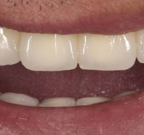 Dental Clinic Turkey Before After Picture Case 15 (Implant Supported Metal Based Porcelain Bridge)